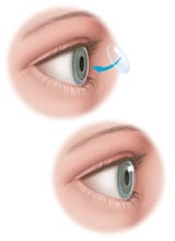 corneal-transplant-vaeye