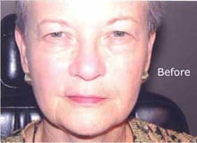 before image of older woman