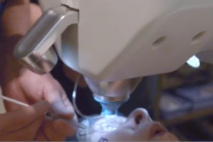 laser assisted cataract surgery