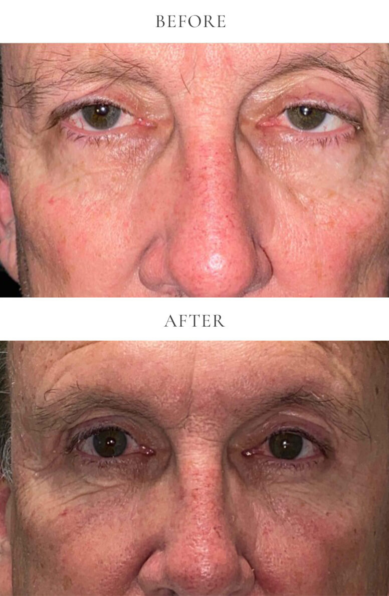 VEI-Before-After-12-WHB-upper-eyelid-bleph-ptosis-repair-lower-eyelid-bleph-fat-transfer-laser-resurfacing-e1712676243179