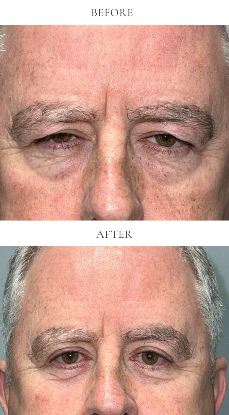 VEI-Before-After-28-NAL-upper-eyelid-bleph-lower-eyelid-bleph-with-fat-transposition-and-lower-eyelid-laser-resurfacing-e1712676283419