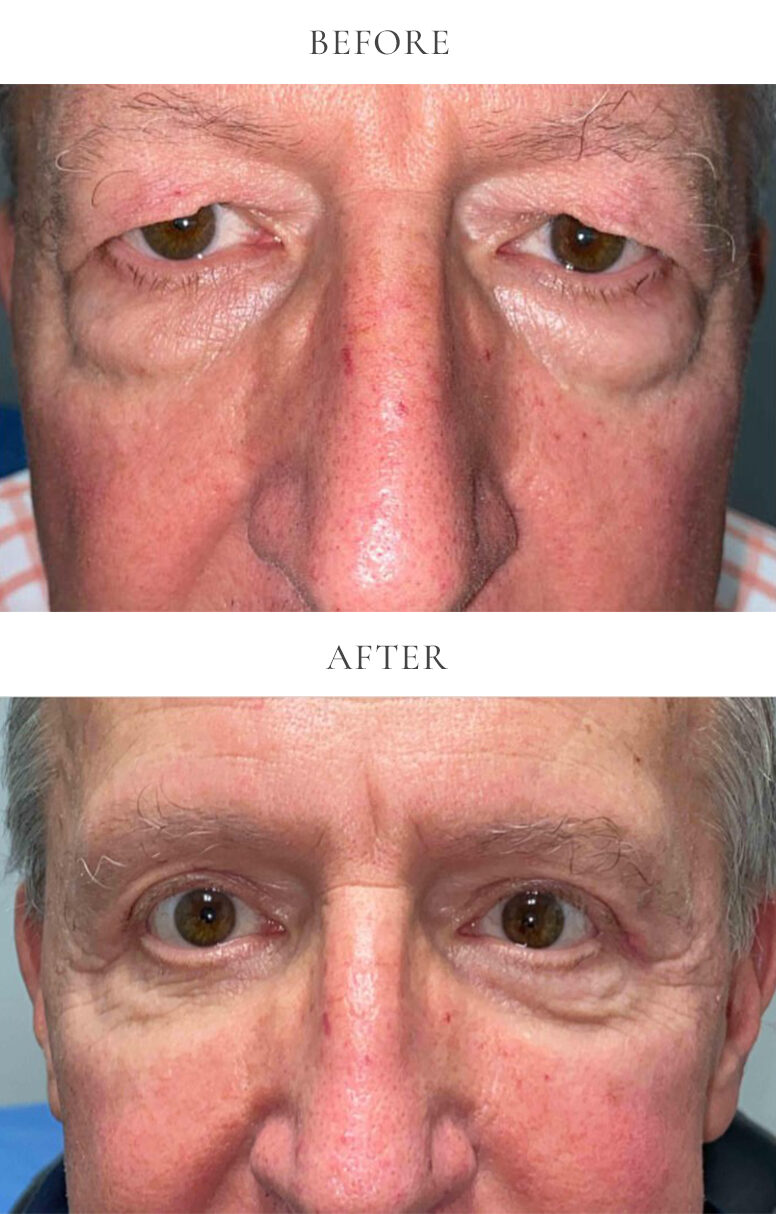VEI-Before-After-6-WHB-upper-eyelid-bleph-lower-eyelid-bleph-e1712674140834